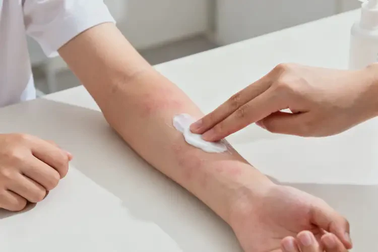 青少年手臂上經(jīng)常長濕疹可以治好嗎(圖2)