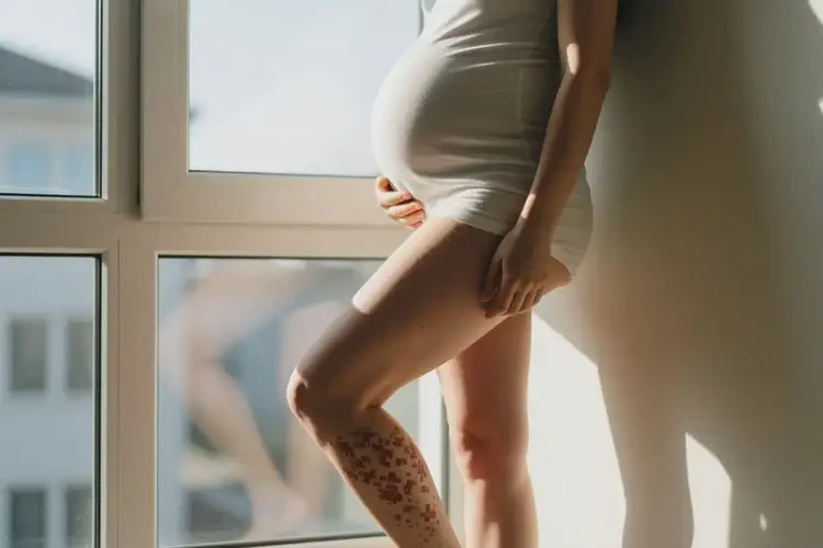 產(chǎn)婦小腿經(jīng)常起濕疹可以治好嗎(圖1)