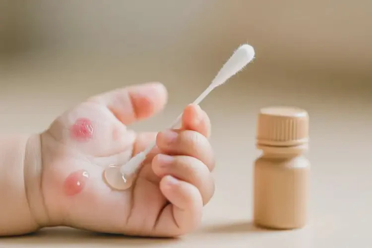 嬰幼兒手上經(jīng)常起濕疹可以治好嗎(圖2)