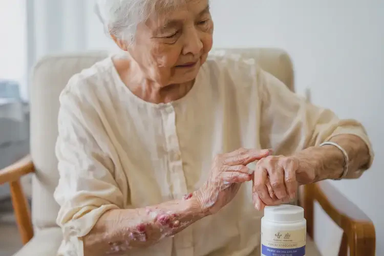 高齡老人手上容易起濕疹能不能徹底自愈(圖2)