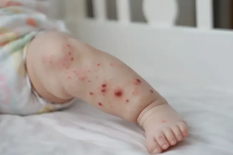 嬰兒小腿偶爾長濕疹可以治好嗎(圖4)