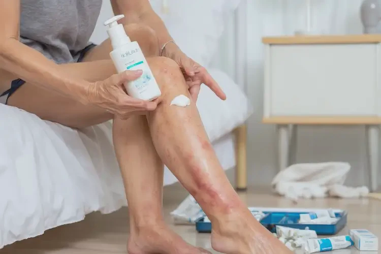 哺乳期媽媽小腿經(jīng)常起濕疹可不可以根治(圖4)