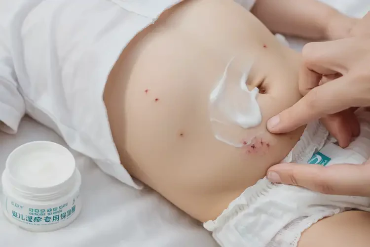 嬰兒肚子上經(jīng)常長濕疹可以治好嗎(圖3)