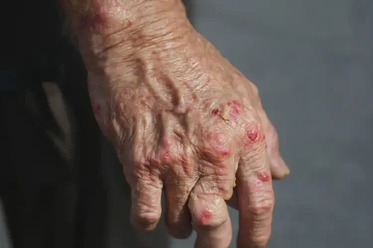 高齡老人手上容易起濕疹能不能徹底自愈(圖4)