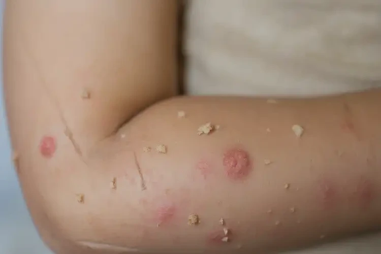 兒童全身有濕疹可以徹底自愈嗎(圖4)