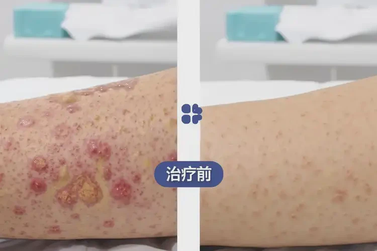 老年人肛周經(jīng)常長濕疹可以治好嗎(圖1)