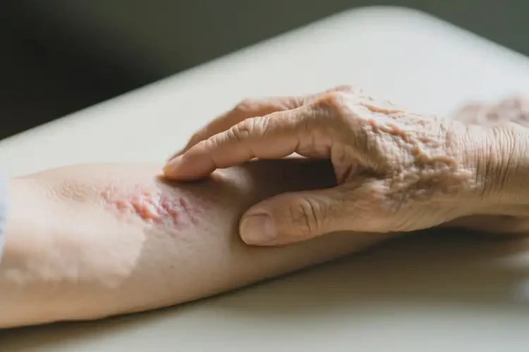 老人手臂上長(zhǎng)濕疹可以治好嗎(圖3)
