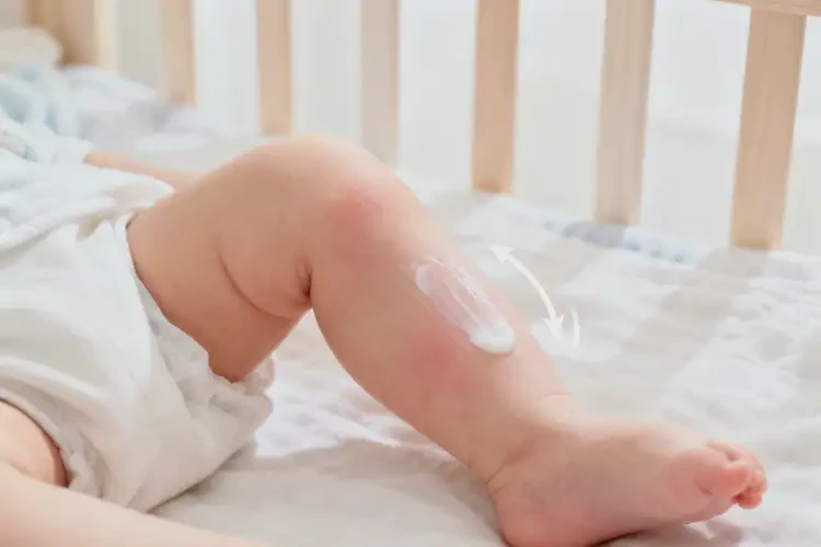嬰兒小腿上偶爾起濕疹可以治好嗎(圖1)