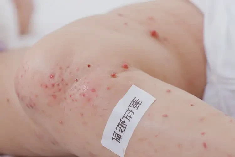 嬰兒大腿經(jīng)常長濕疹可以治好嗎(圖4)