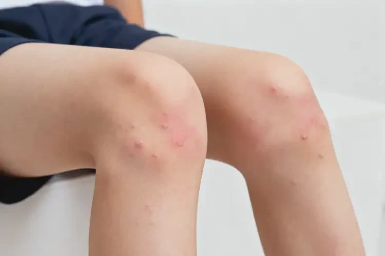 青少年大腿上出現(xiàn)濕疹可以徹底自愈嗎(圖4)