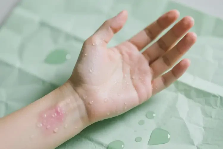 青年人手臂經(jīng)常長(zhǎng)濕疹可不可以根治(圖1)