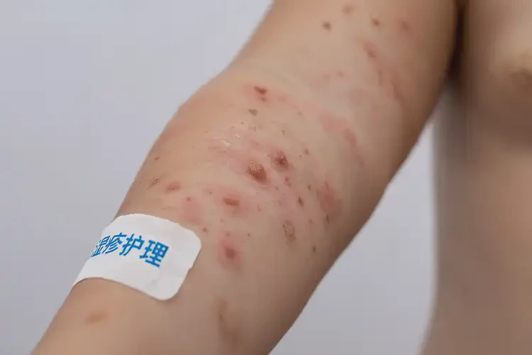 小兒手臂上有濕疹可以治好嗎(圖4)