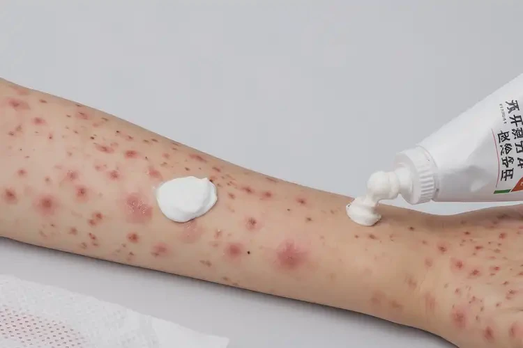 青少年手臂上有濕疹可不可以根治(圖3)