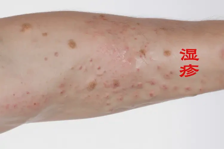 男生手臂出現(xiàn)濕疹可不可以根治(圖4)