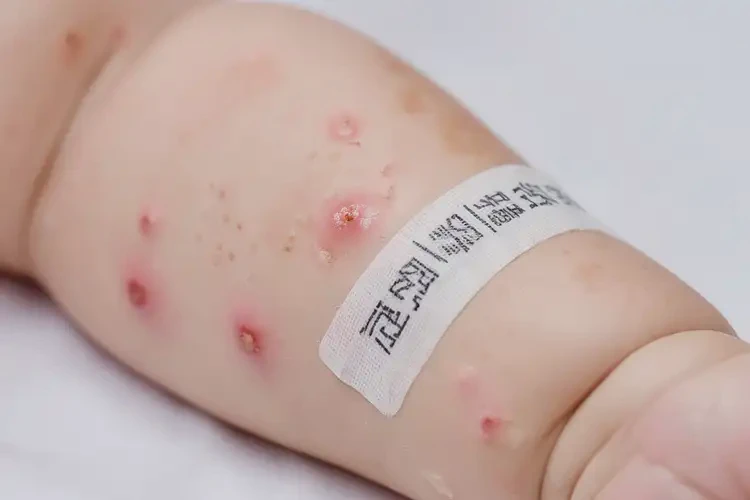 嬰幼兒手臂出現(xiàn)濕疹可以治好嗎(圖4)