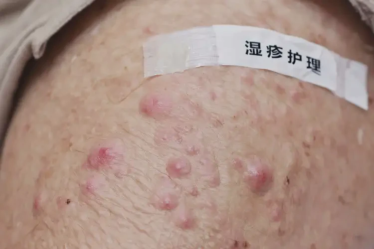 老人大腿上出濕疹可以治好嗎(圖4)