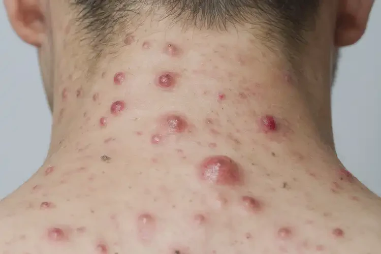 青年人脖子上長(zhǎng)濕疹可以治好嗎(圖4)