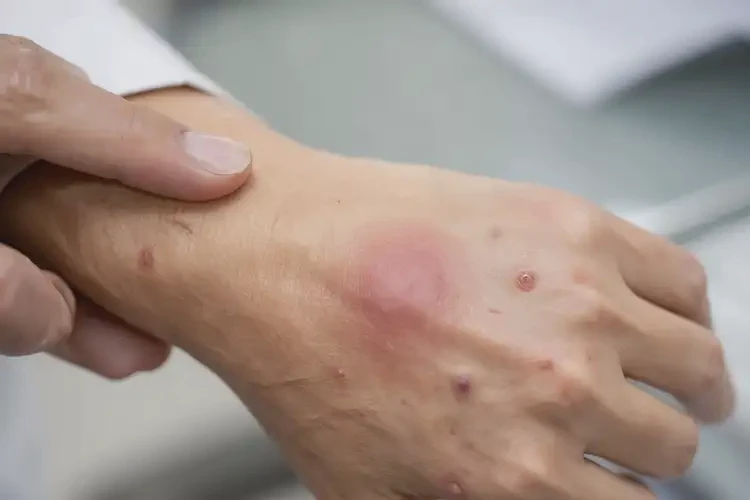 男人大腿容易長濕疹可不可以根治(圖4)