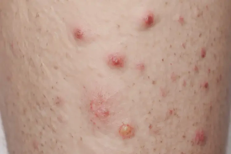 女生身上容易起濕疹不管它會自己好嗎(圖3)