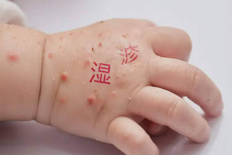 孩子手上有濕疹可以治好嗎(圖4)