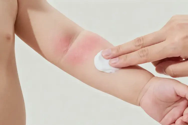 嬰兒手臂上長濕疹可以治好嗎(圖2)