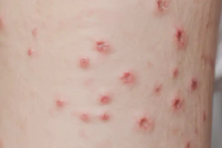 小學(xué)生大腿容易起濕疹可以治好嗎(圖4)