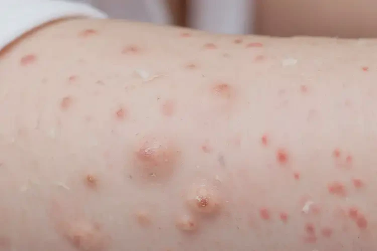 小孩身上經(jīng)常起濕疹可以治好嗎(圖4)