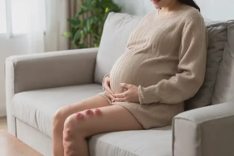 孕婦小腿出現(xiàn)濕疹不管它會自己痊愈嗎(圖1)
