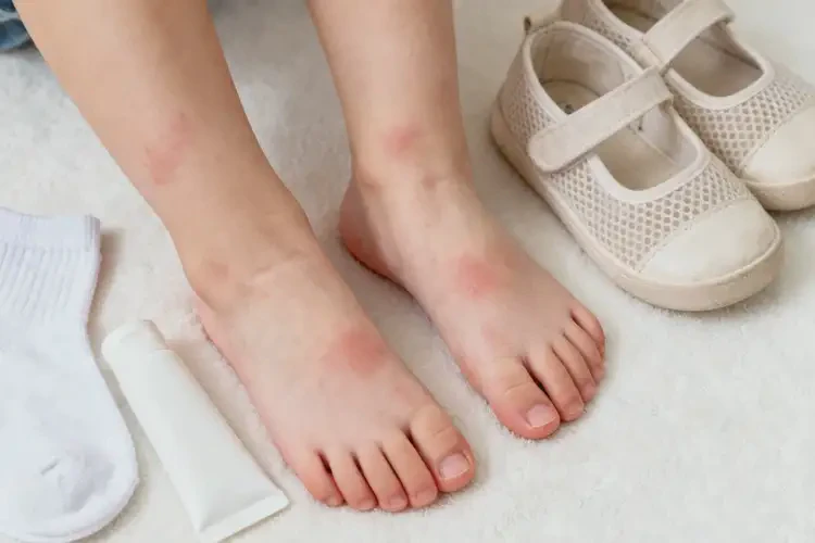 小學(xué)生腳上出濕疹可以徹底自愈嗎(圖1)