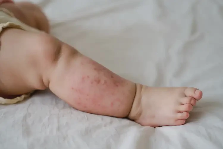 寶寶大腿上出濕疹可不可以徹底自愈(圖2)