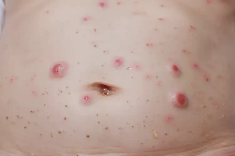 新生兒肚子出現(xiàn)濕疹可以治好嗎(圖4)
