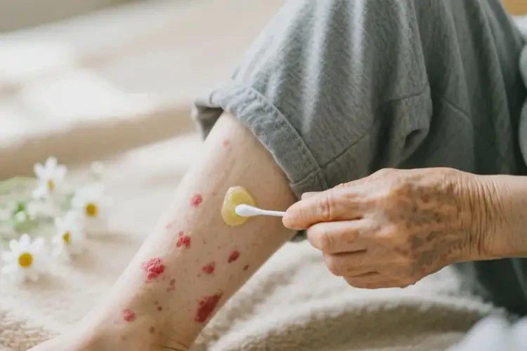 老人四肢偶爾起濕疹可以治好嗎(圖3)