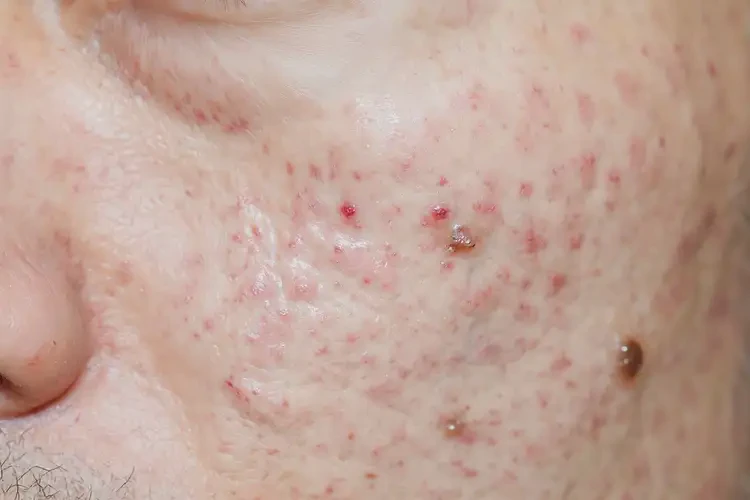 青年人肛周出濕疹可以治好嗎(圖4)