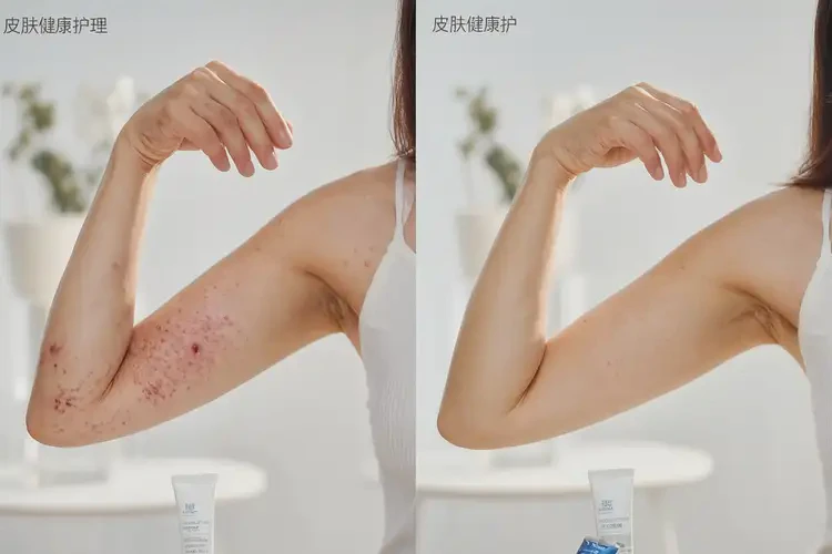 女性手臂上容易長(zhǎng)濕疹可以治好嗎(圖1)