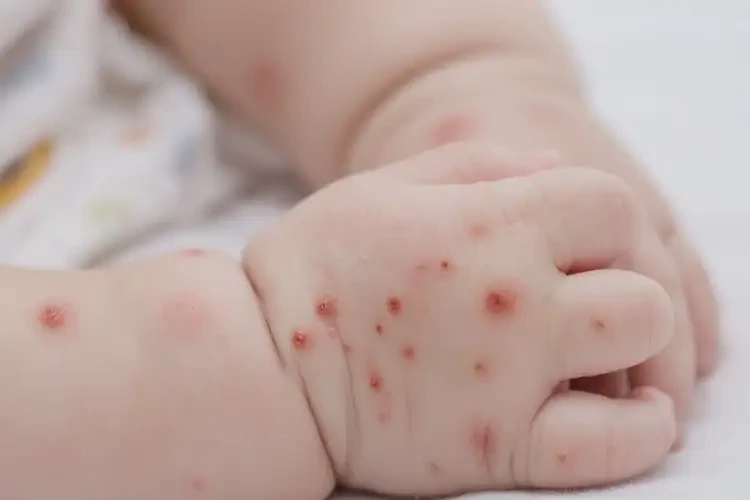 寶寶手上容易起濕疹可以治好嗎(圖4)