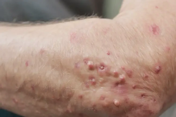 老人手臂上經常起濕疹可以治好嗎(圖4)