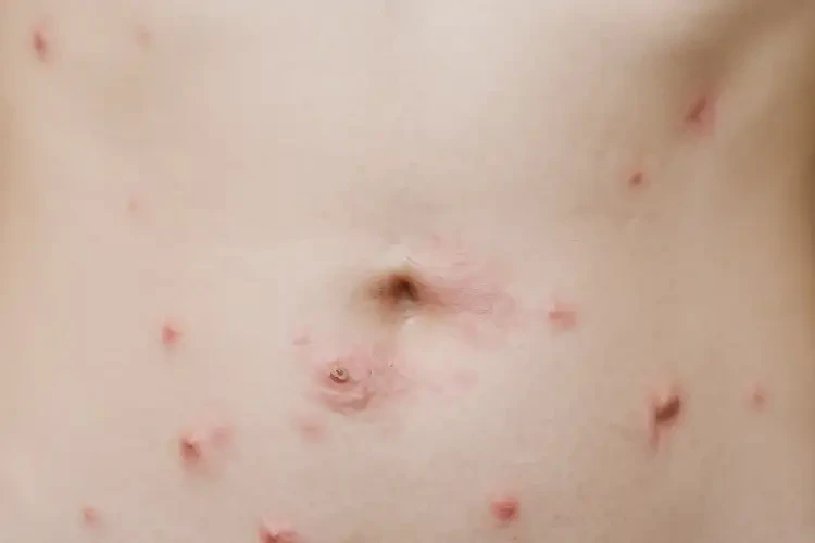 女生肚子上有濕疹可以治好嗎(圖4)