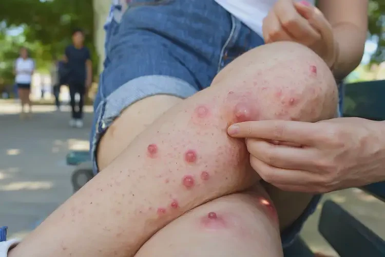 大學(xué)生小腿起濕疹可以治好嗎(圖4)