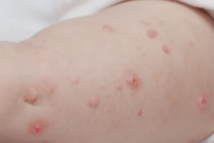 嬰兒大腿上出濕疹可以治好嗎(圖4)