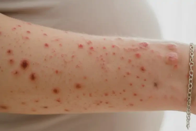 孕婦手臂上起濕疹可以治好嗎(圖4)
