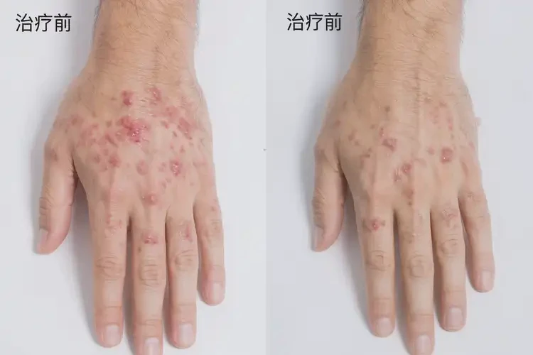 青年人手上容易起濕疹可以治好嗎(圖4)