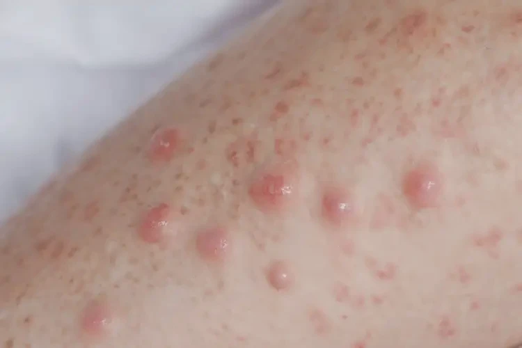 女生小腿偶爾長濕疹不管它會自己好嗎(圖3)