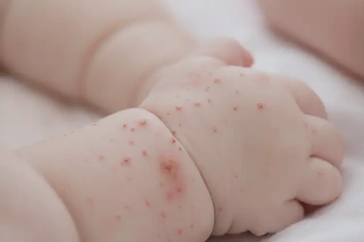 嬰兒手臂上出濕疹可以治好嗎(圖4)