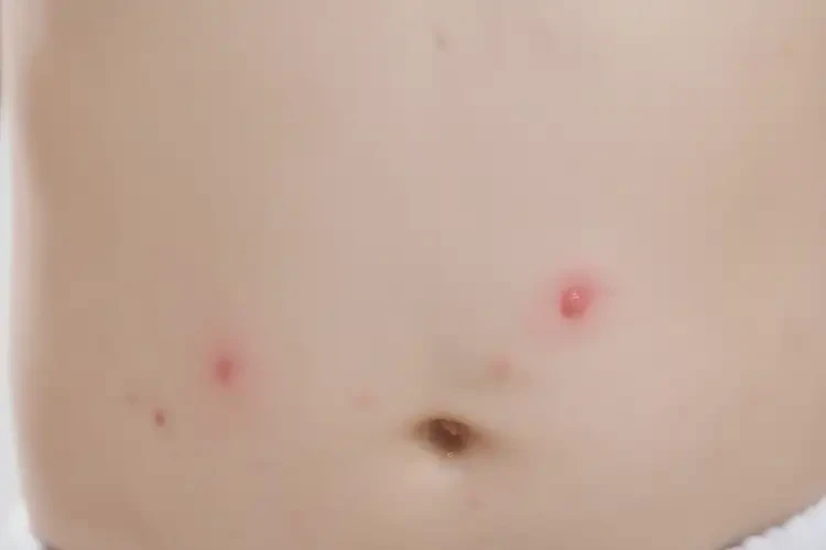 小孩肚子上長濕疹可以治好嗎(圖4)