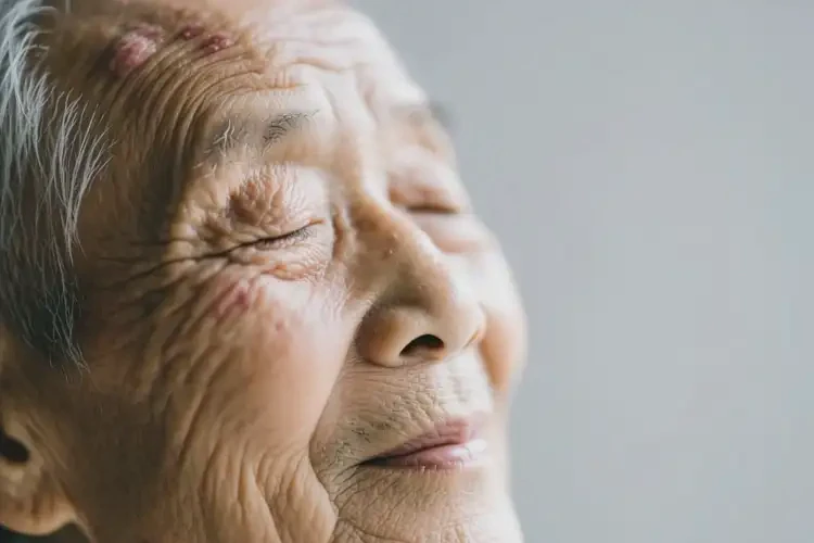 老人面部偶爾起濕疹可以治好嗎(圖2)