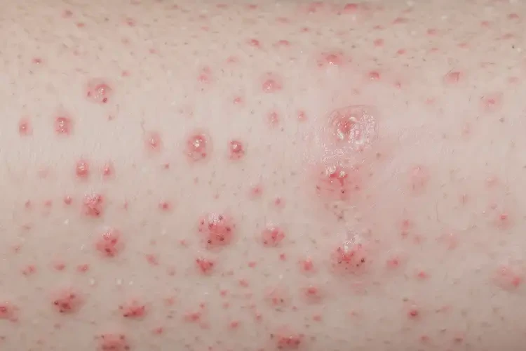 女生身上出現(xiàn)濕疹可以治好嗎(圖4)