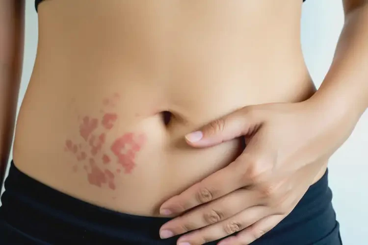 女人肚子上有湿疹可不可以根治(图4)