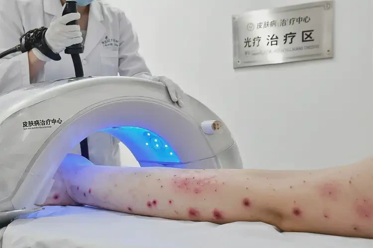 大學(xué)生四肢有濕疹可不可以根治(圖2)