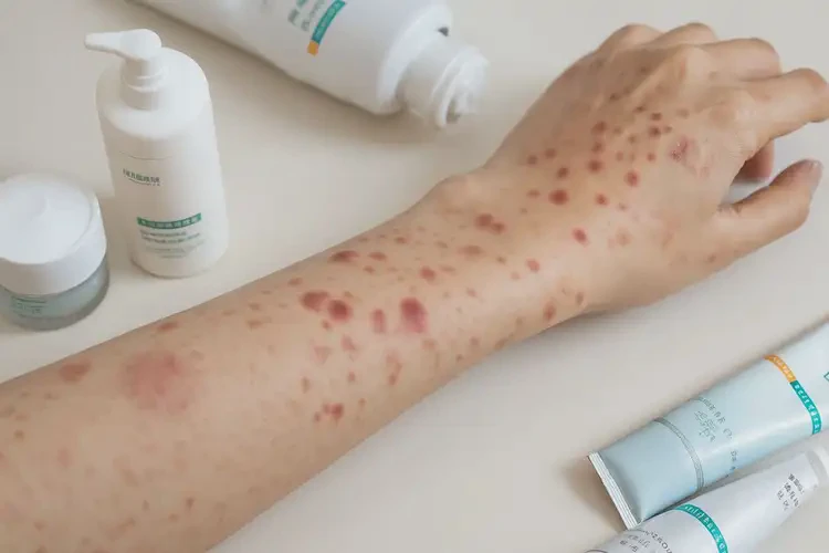大學生手上經(jīng)常起濕疹可以徹底自愈嗎(圖4)