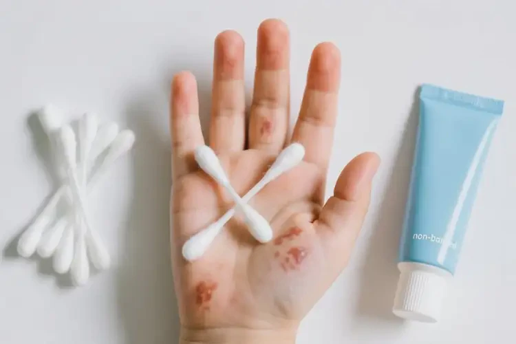 小兒手上容易長(zhǎng)濕疹可以治好嗎(圖1)